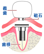 アタッチメント義歯