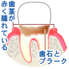 初期歯周炎