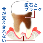 重度歯周炎